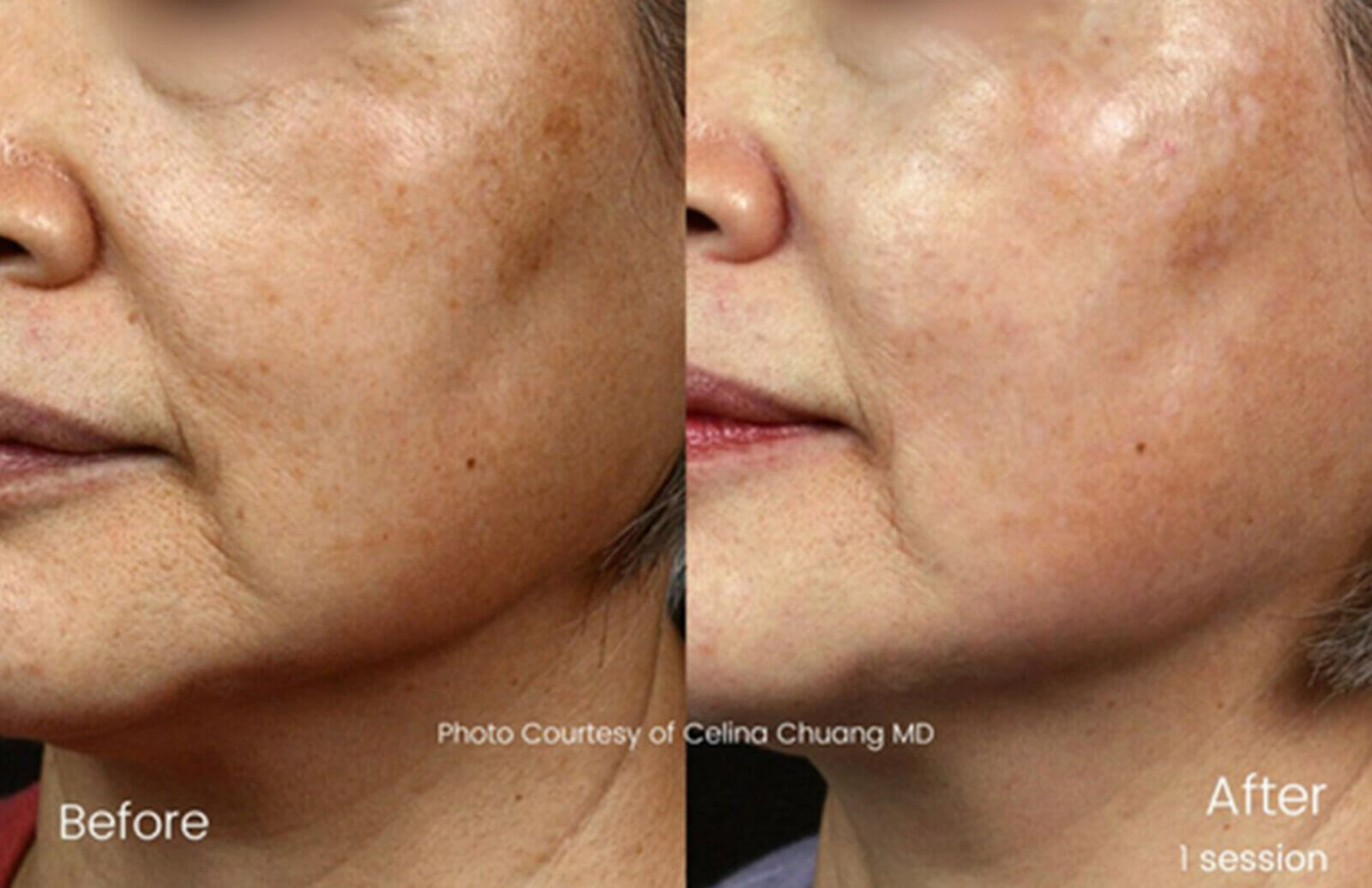 Picosecond Laser Technology's Newest Marvels Introduced