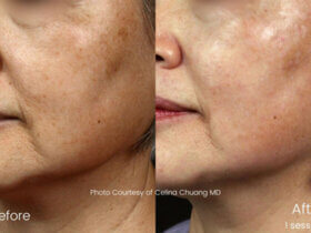 Picosecond Laser Technology's Newest Marvels Introduced