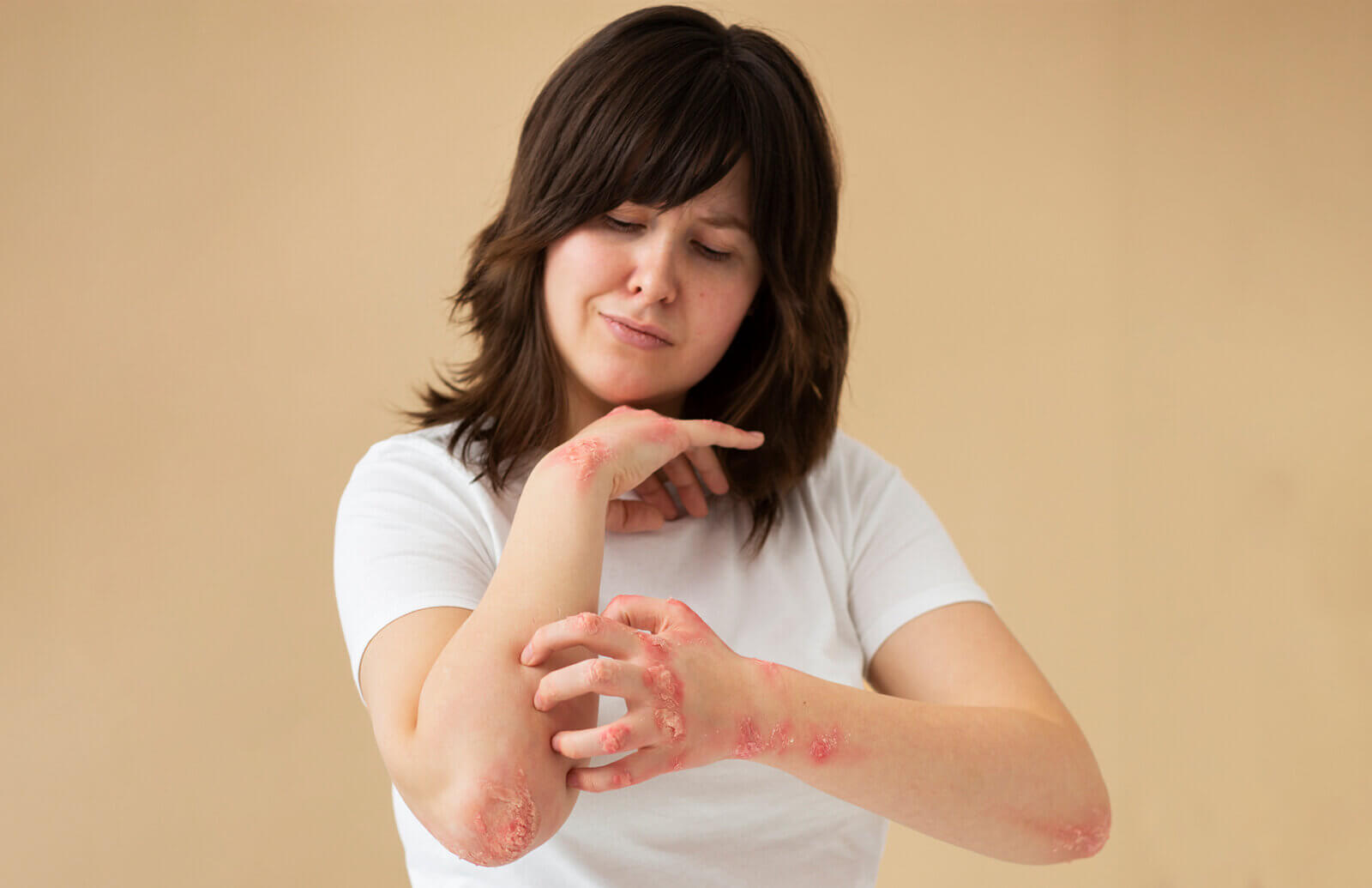 Psoriasis Crisis: Dermacon 2024 Calls Stress, Pollution Action!