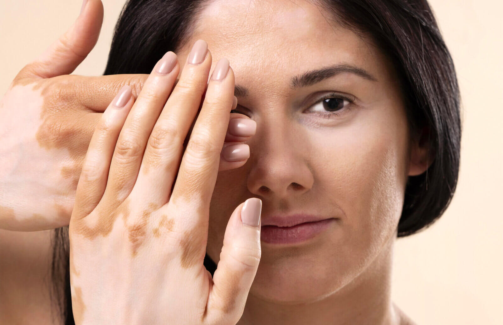 Micropigmentation Offers a Beacon of Hope for Vitiligo Patients