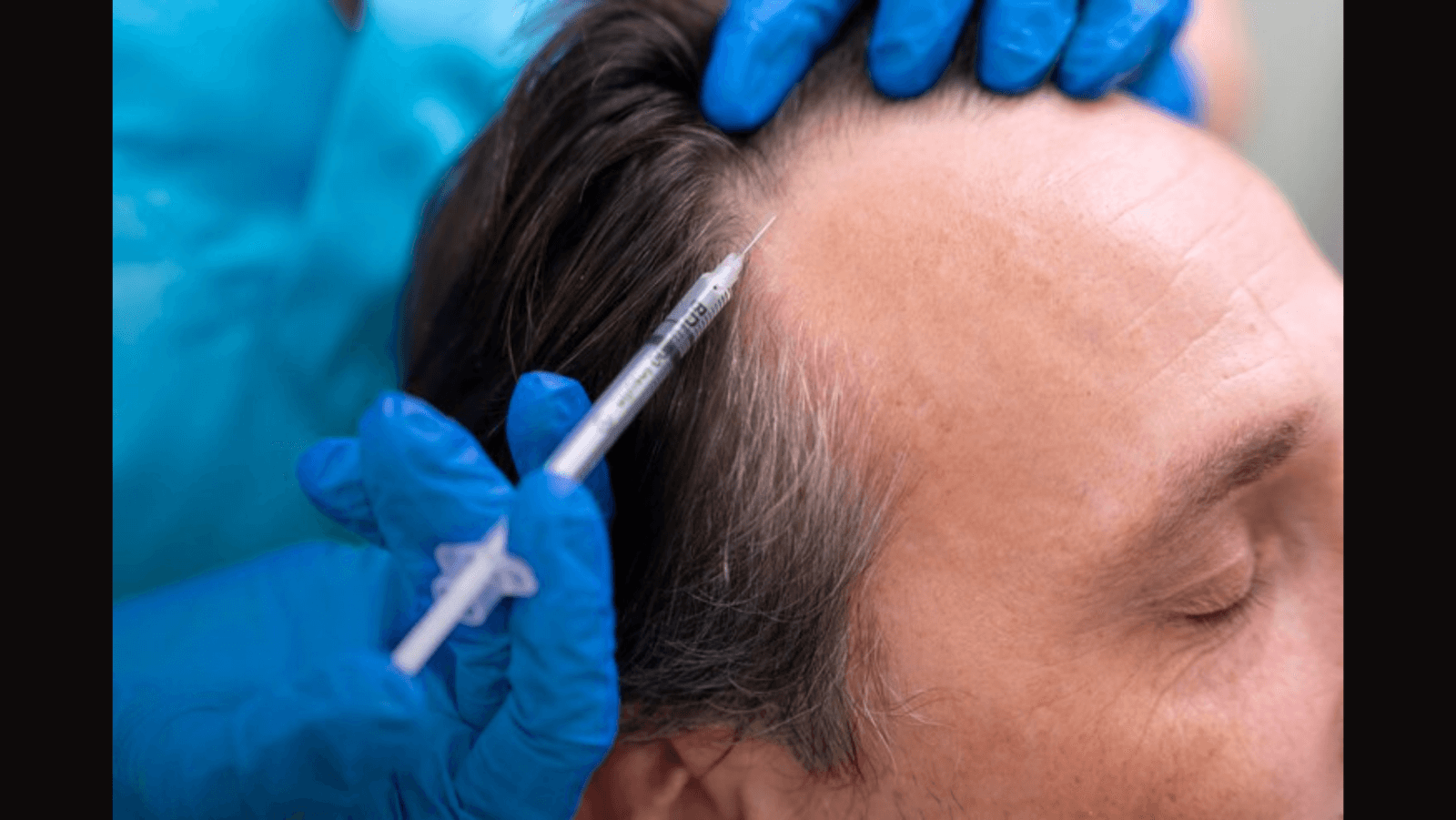 Exosome therapy is transforming hair growth and restoration