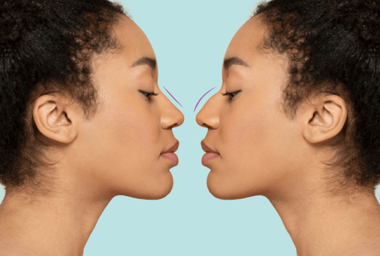 Nose Reconstruction Market Soars—$6.1B by 2030!