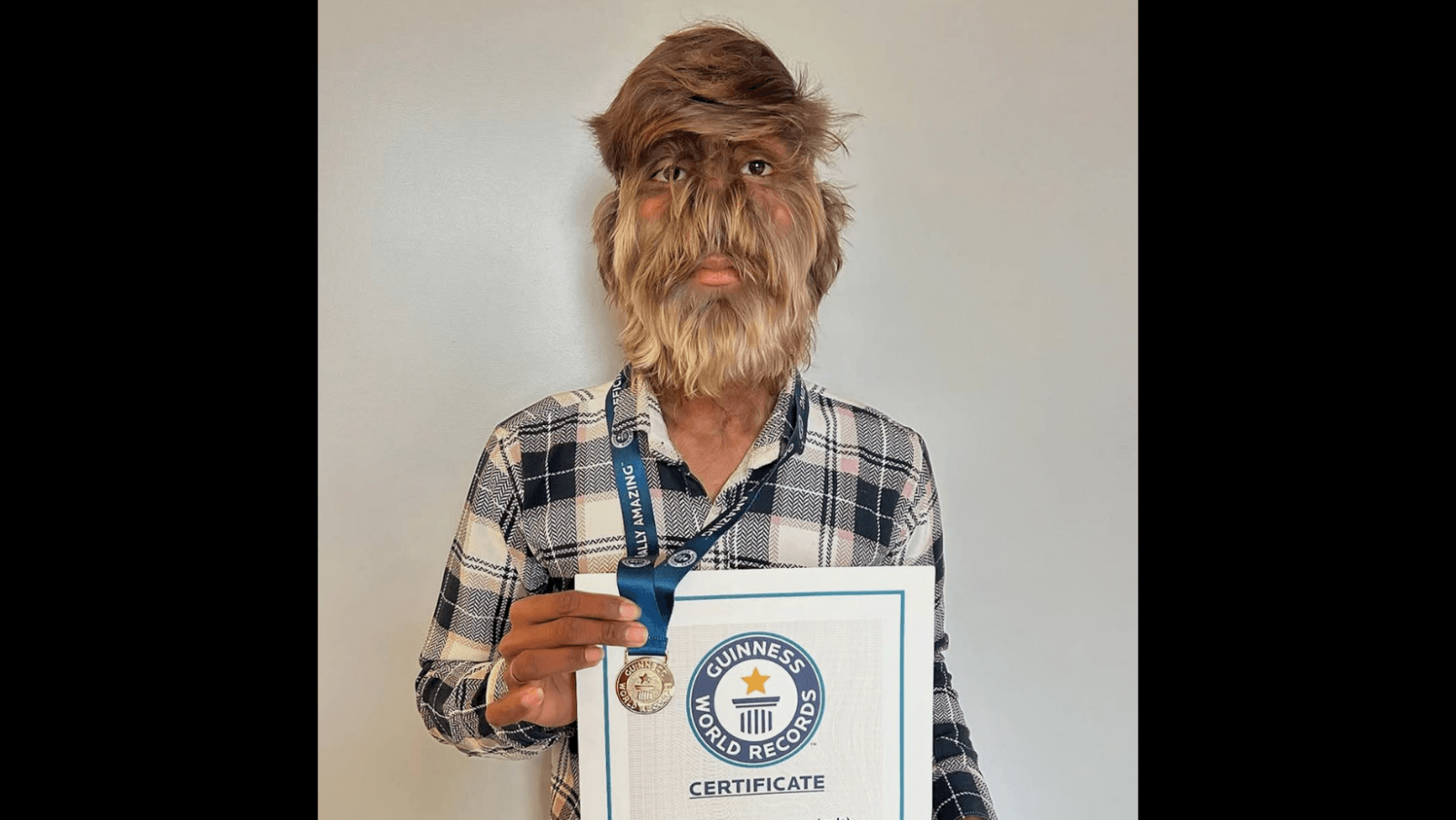 Lalit Patidar sets Guinness record for hairiest face