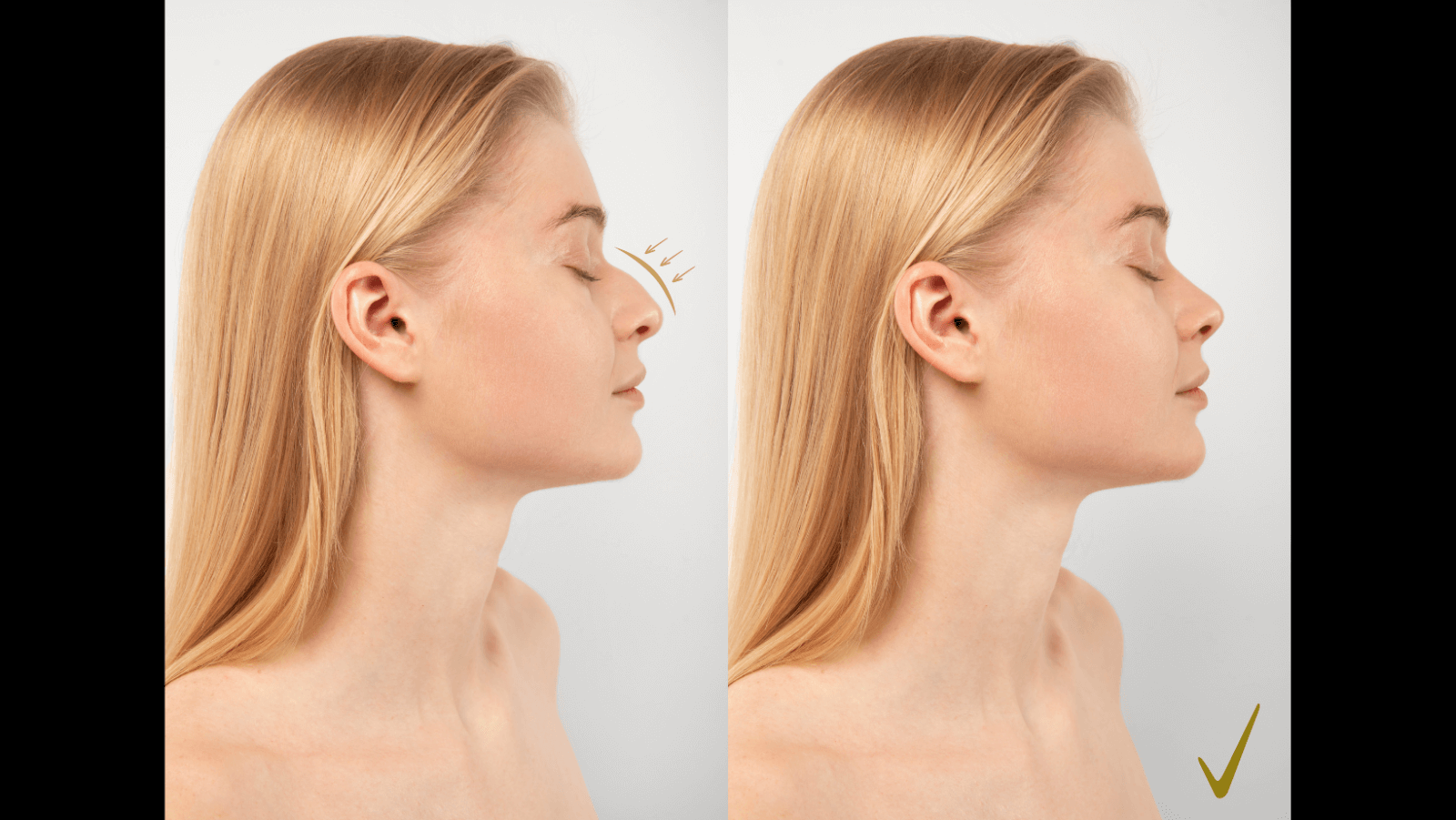 Rhinoplasty Market Set for Growth by 2032