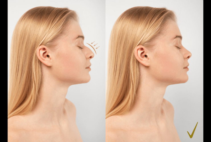 Rhinoplasty Market Set for Growth by 2032