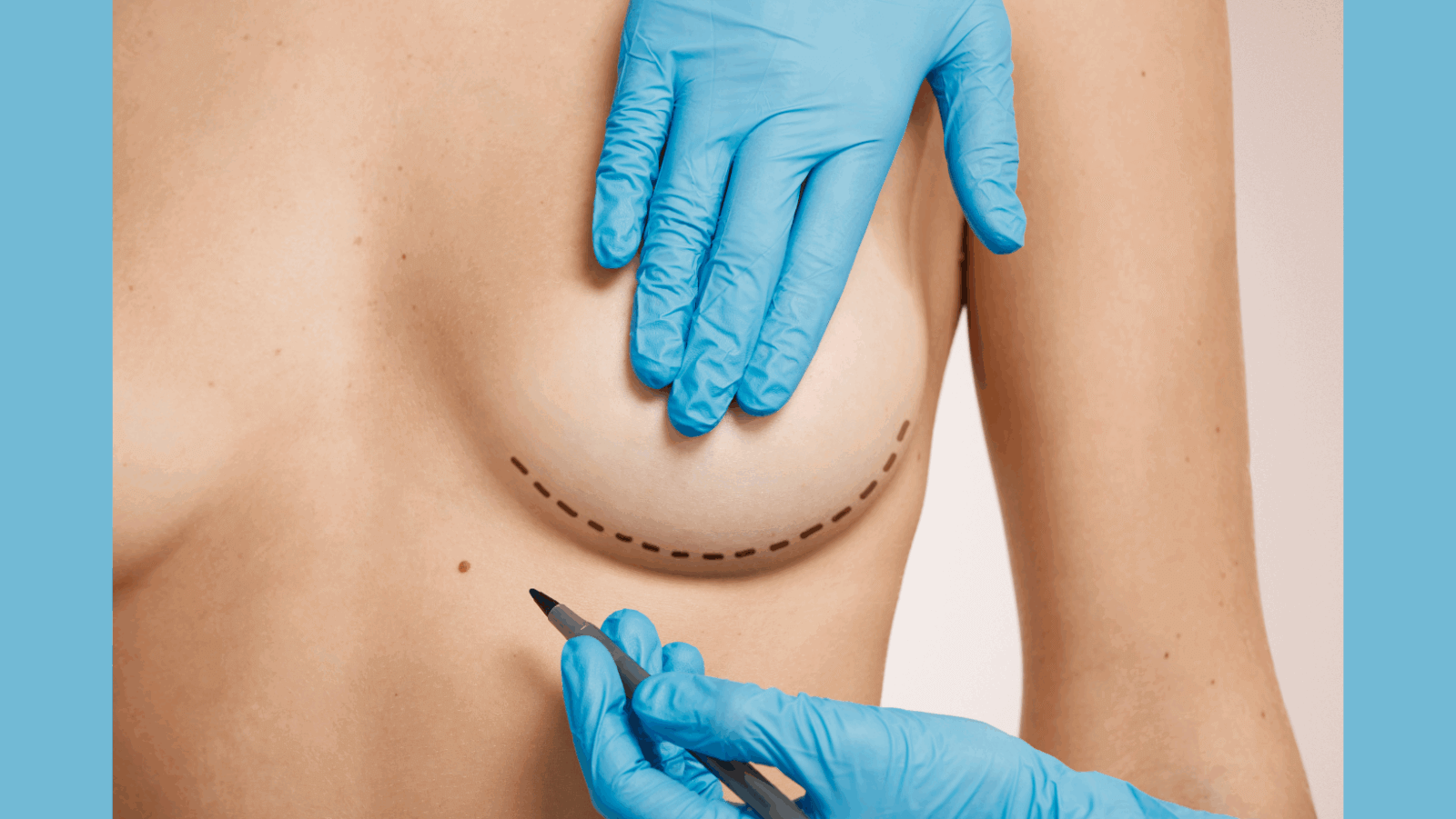 Reduction mammoplasty