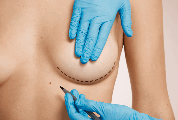 Reduction mammoplasty