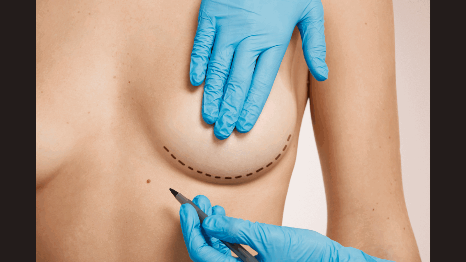 Breast augmentation market to hit $3.4B by 2031