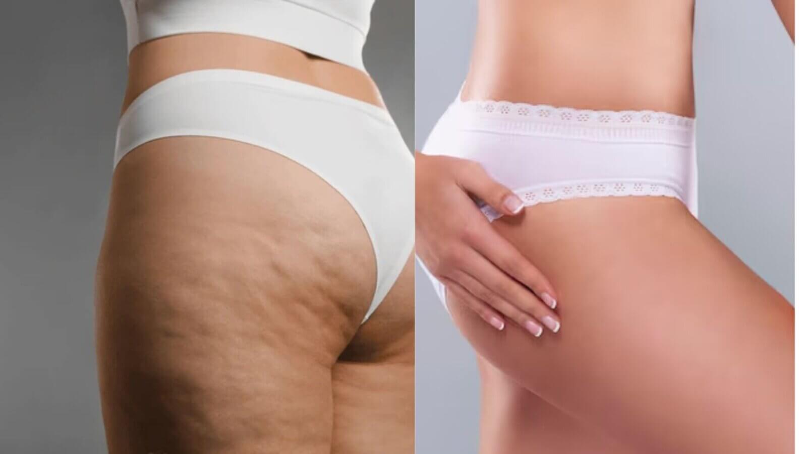 Cellulite treatment market poised for strong growth