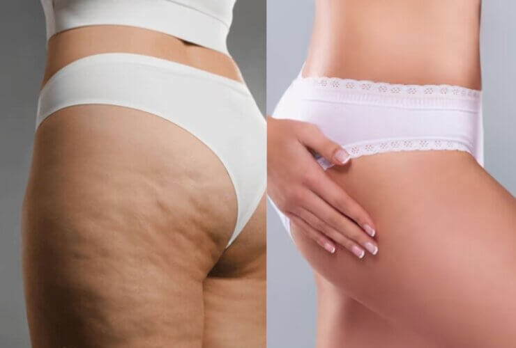 Cellulite treatment market poised for strong growth