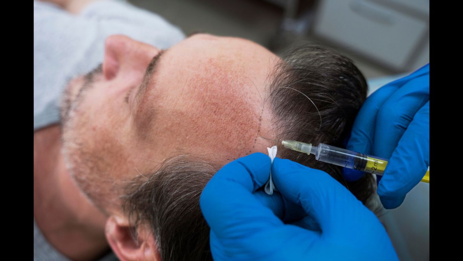 QR678 Neo® sets new global standard in hair transplants