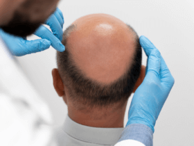 Hair transplant procedures in India becoming a global choice