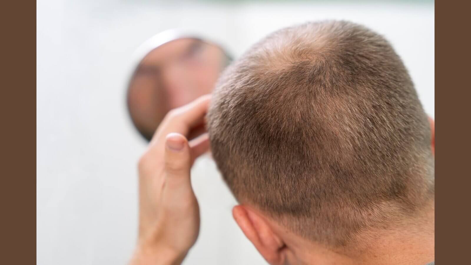 Topical clascoterone 5% shows major hair regrowth results