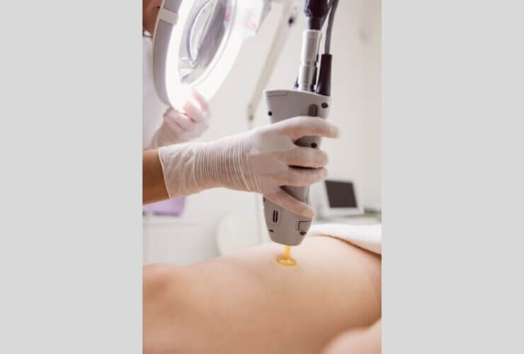 Laser-assisted liposuction market to hit $4.64B by 2033