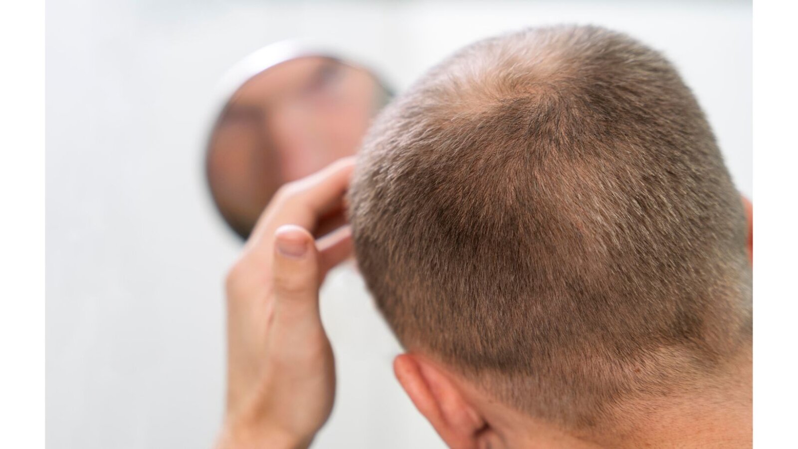 Men choose undetectable hair restoration