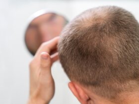 Men choose undetectable hair restoration