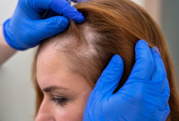 Blood tests can reveal hidden causes of hair loss