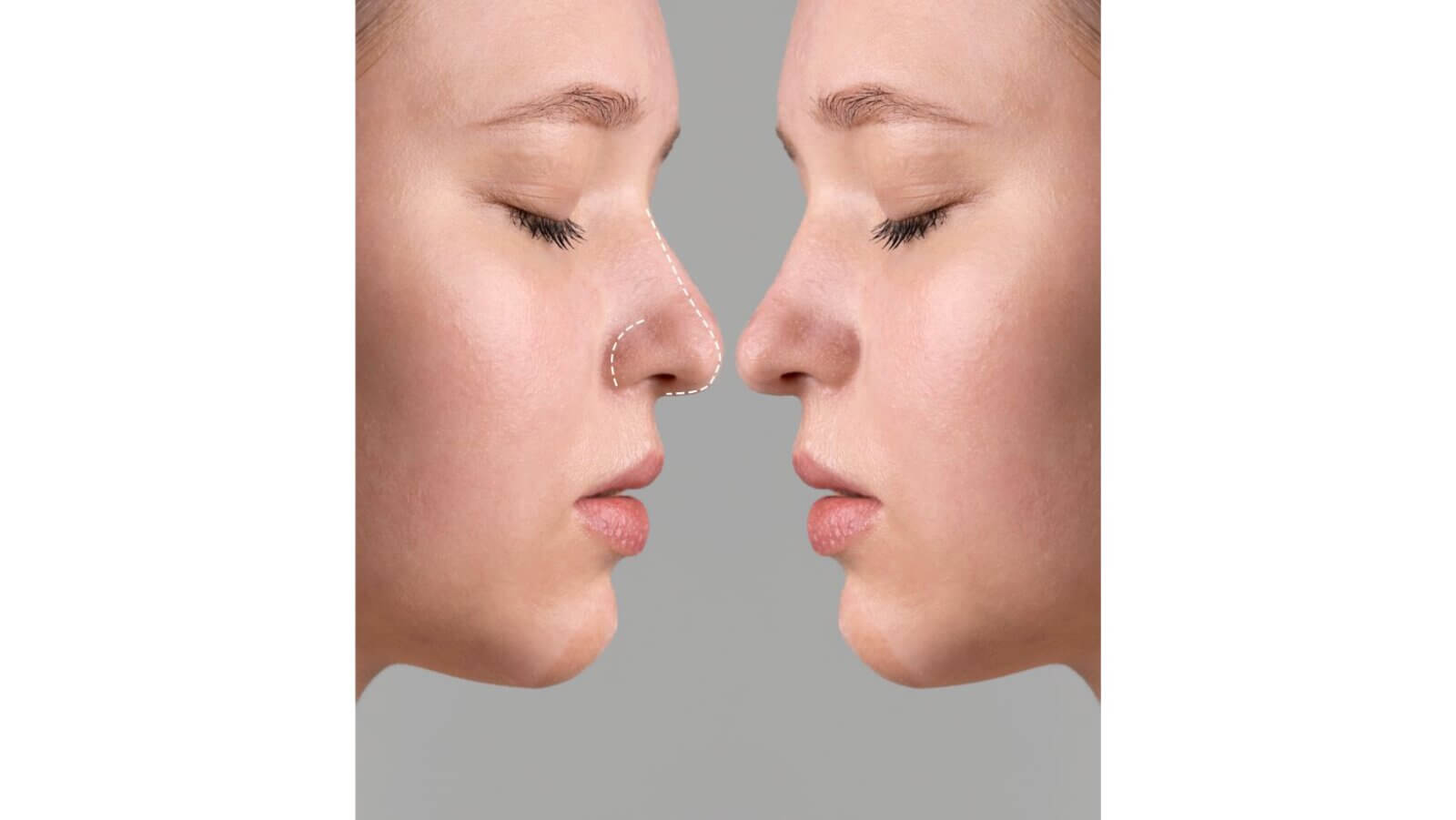 Rhinoplasty trend prioritises subtler, faster procedures