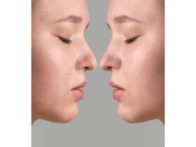 Rhinoplasty trend prioritises subtler, faster procedures