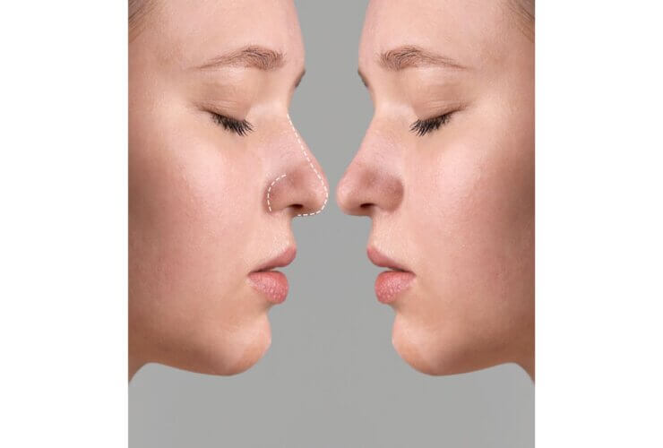 Rhinoplasty trend prioritises subtler, faster procedures