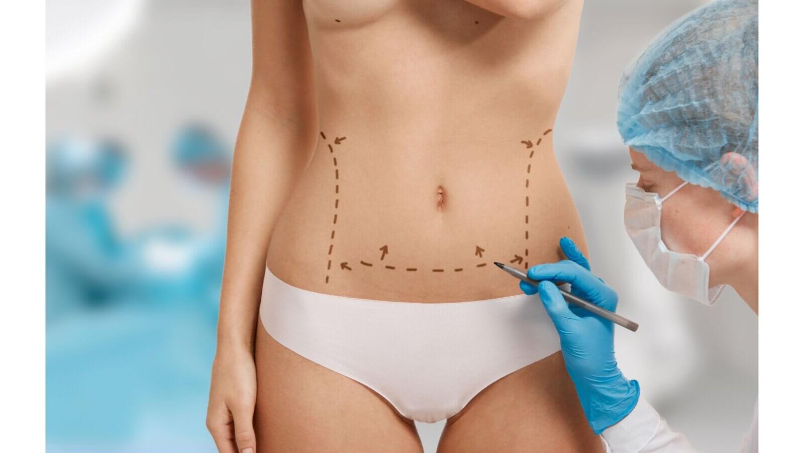 Tummy-tuck surgery eases back pain and urinary incontinence