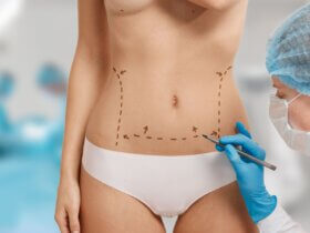 Tummy-tuck surgery eases back pain and urinary incontinence