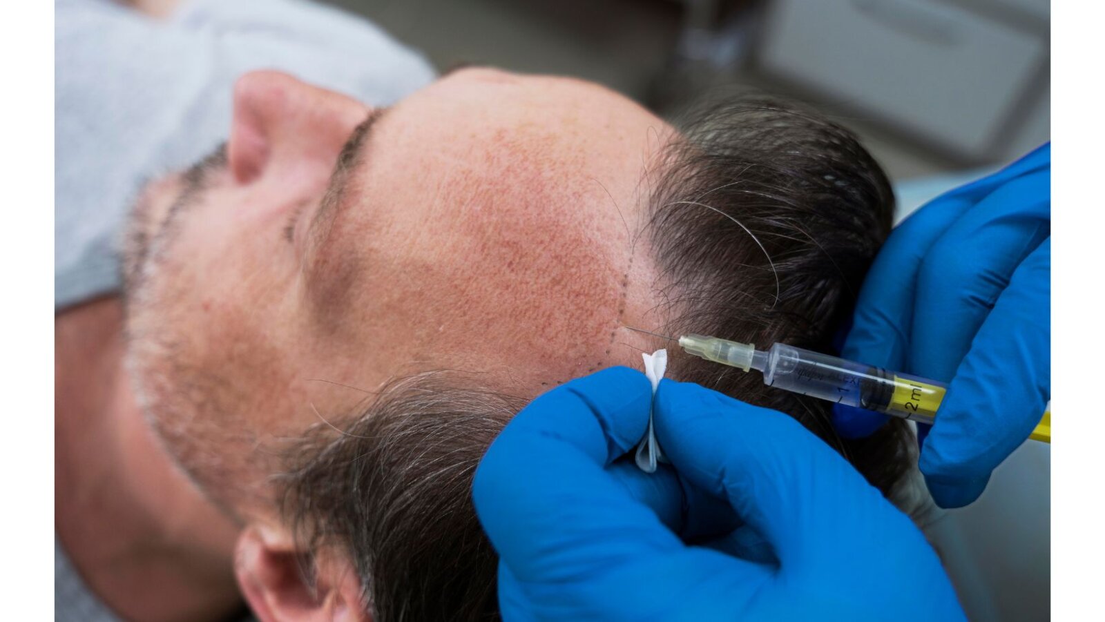 CRLAB and Hairline International launch non-surgical hair solutions