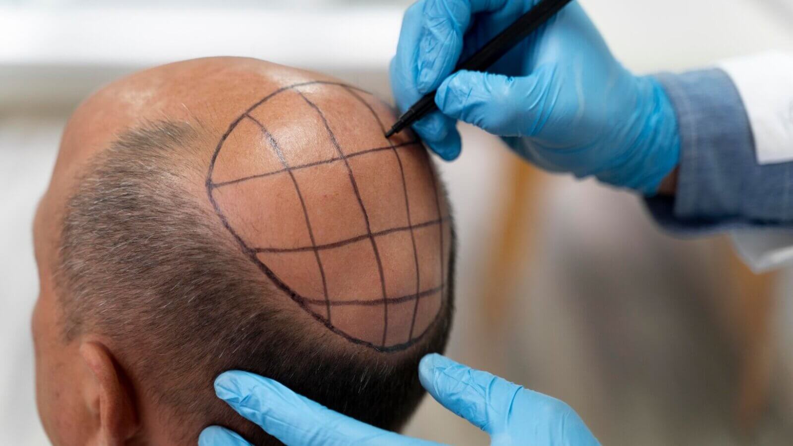 Hair transplant system market to hit $44B by 2032