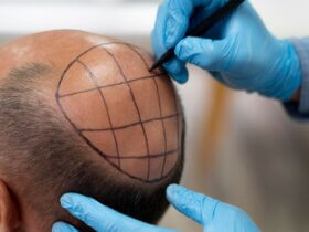 Hair transplant system market to hit $44B by 2032