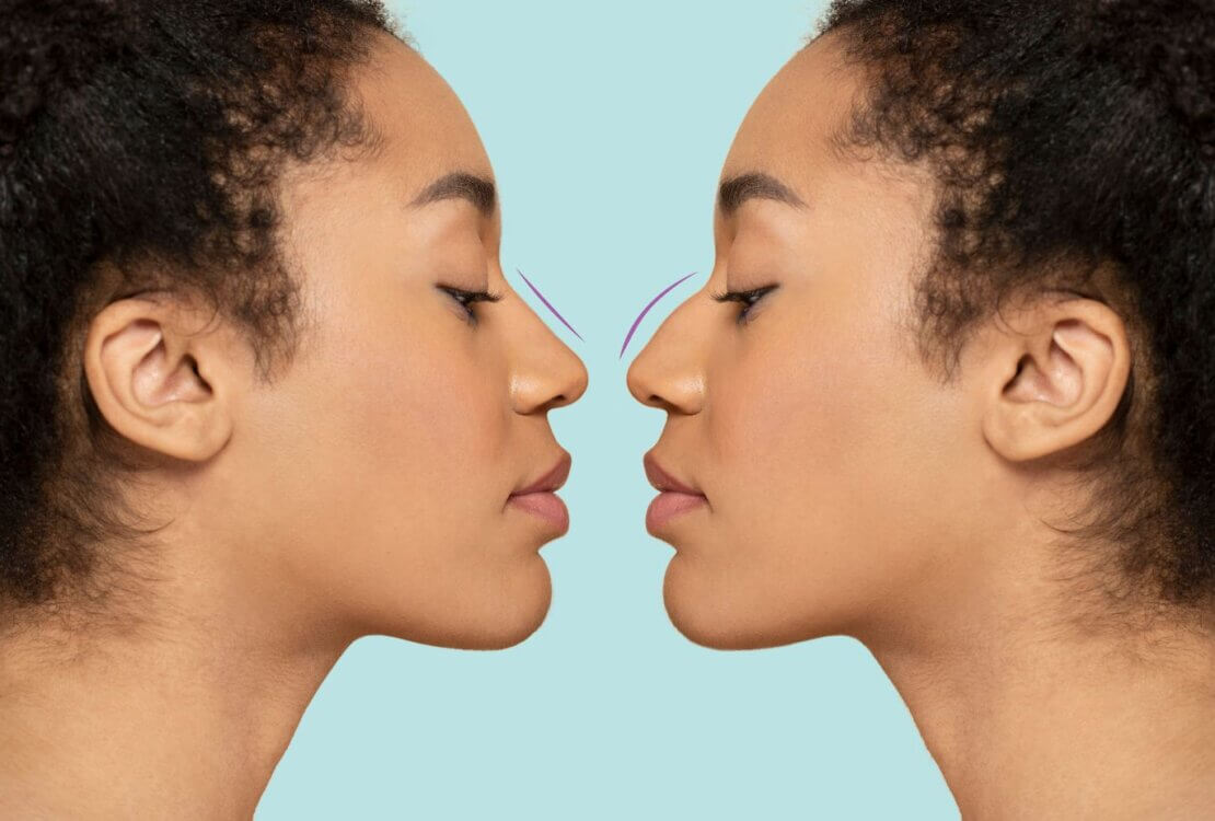 Ethnic rhinoplasty trend reshapes nose surgery standards