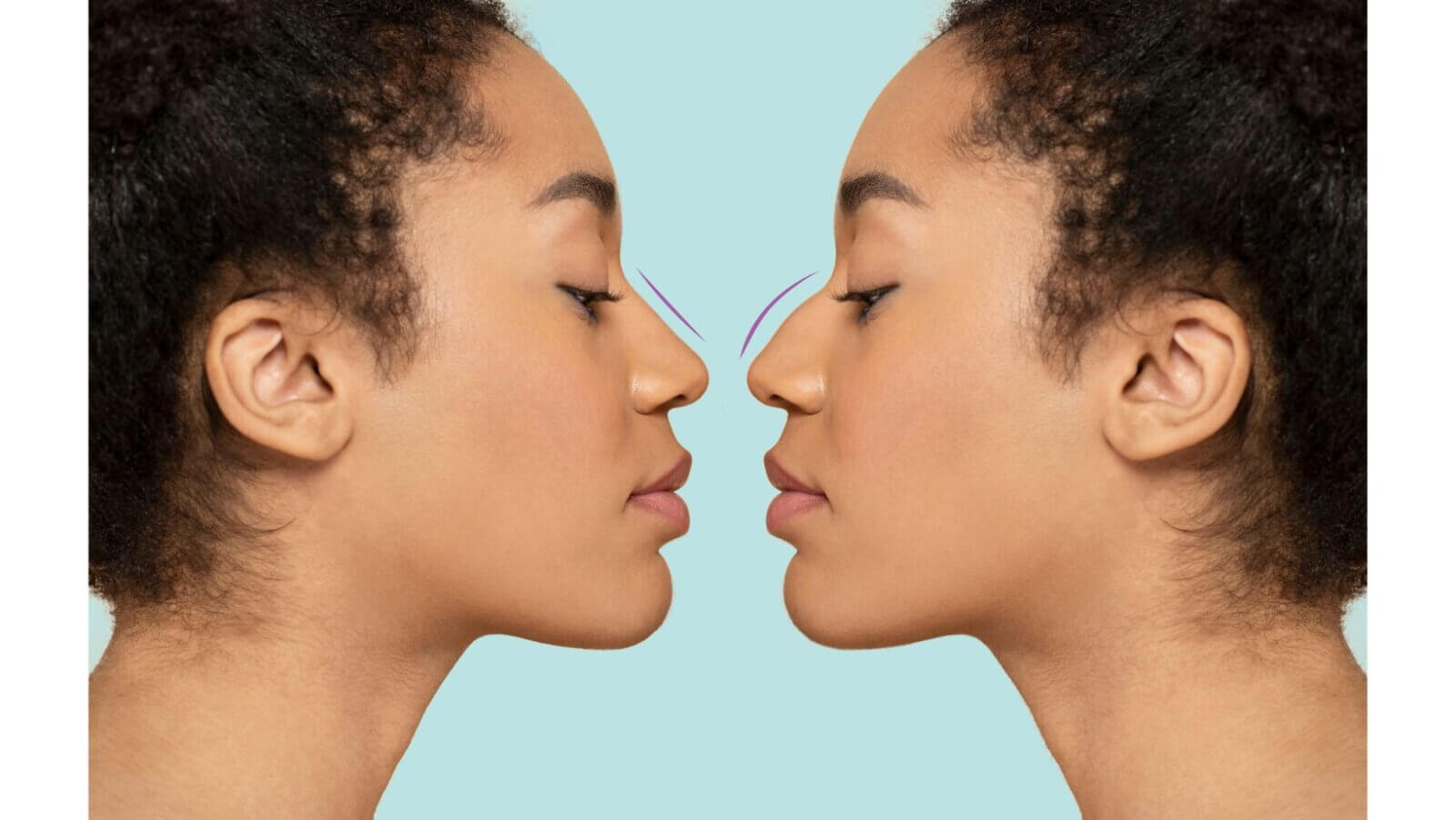 Ethnic rhinoplasty trend reshapes nose surgery standards