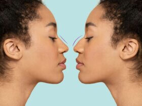 Ethnic rhinoplasty trend reshapes nose surgery standards
