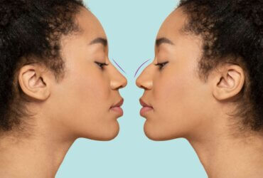 Ethnic rhinoplasty trend reshapes nose surgery standards