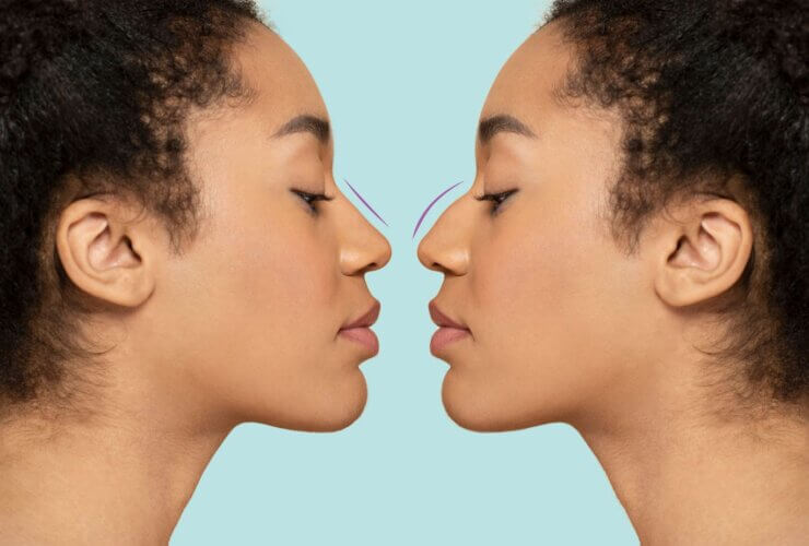 Ethnic rhinoplasty trend reshapes nose surgery standards