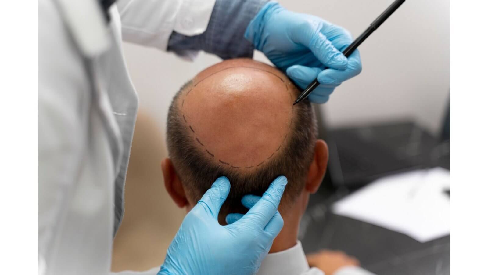 FUE hair transplant techniques highlighted at DMCH