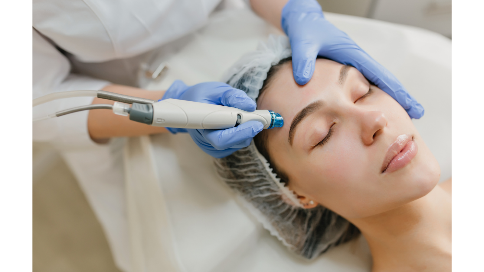 Microneedling with TXA shows promise for melasma