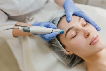 Microneedling with TXA shows promise for melasma