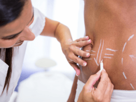 Non-invasive body contouring gains momentum