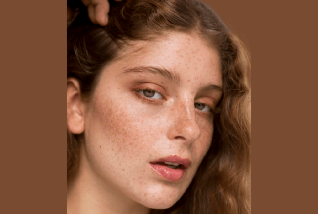 Facial hyperpigmentation: New review urges broader approach