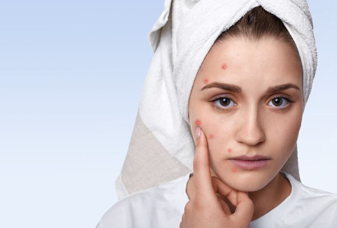 Acne treatment shifts toward personalised care models
