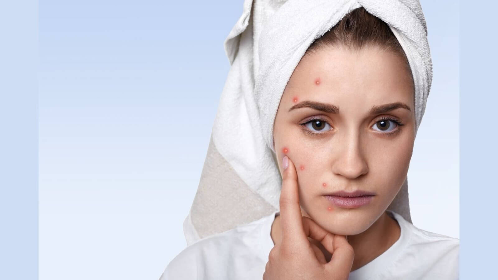 Acne treatment shifts toward personalised care models