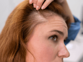 Dr M. D. Sindhura: Diagnosis key in hair loss treatment