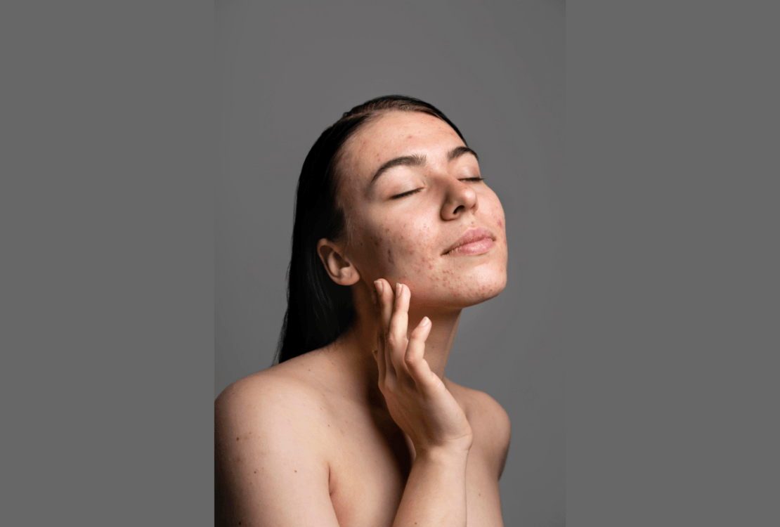 Body acne cases surge in Bengaluru amid rising heat