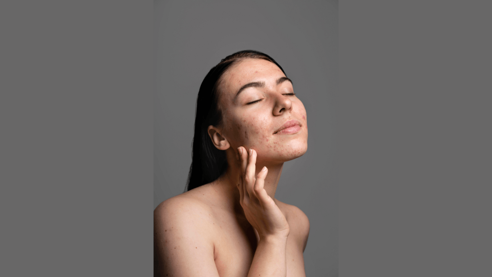 Body acne cases surge in Bengaluru amid rising heat