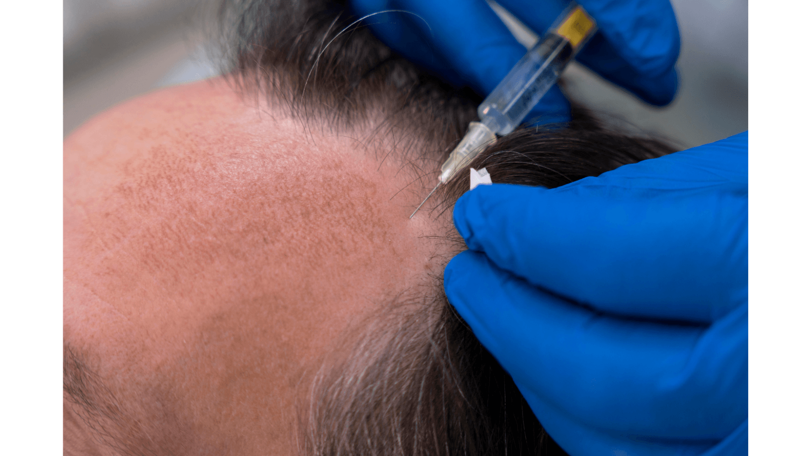 MedLinks launches Elyara Hair Filler for hair loss care